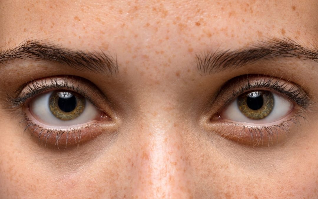 Hyperpigmentation: Causes, Symptoms, Treatment, Types, And More