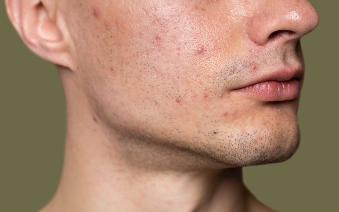 Acne: Causes, Symptoms, Treatment, Prevention, and More